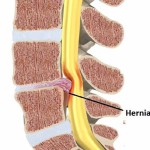 Causas de aparición de la HERNIA DISCAL.